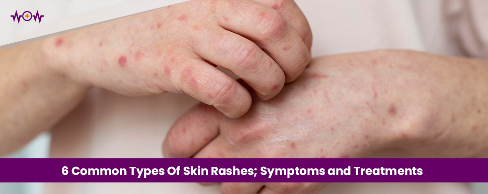 6 Common Types Of Skin Rashes; Symptoms and Treatments