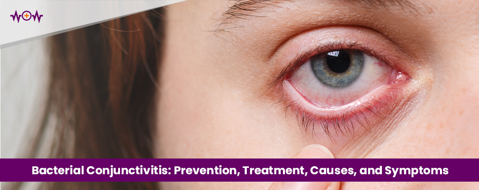 Battling Bacterial Conjunctivitis: Prevention, Treatment, Causes, and Symptoms